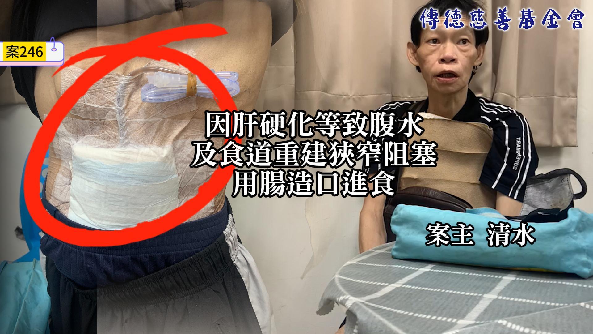 【246已結案】肝硬化及食道狹窄雙重打擊，中年男無法謀生自立(標題圖檔)