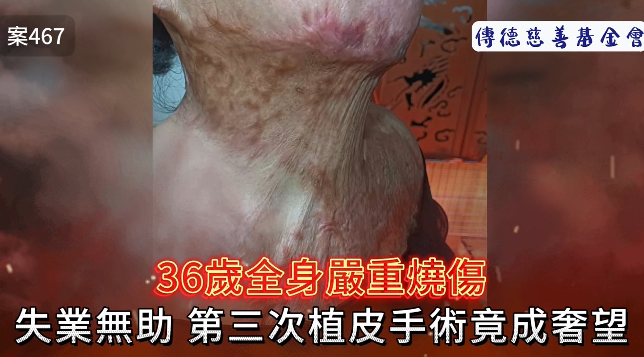 36歲全身嚴重燒傷，失業無助，第三次植皮手術竟成奢望！(標題圖檔)