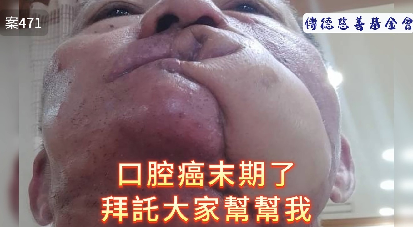 口腔癌末期了..拜託大家幫幫我!!(標題圖檔)