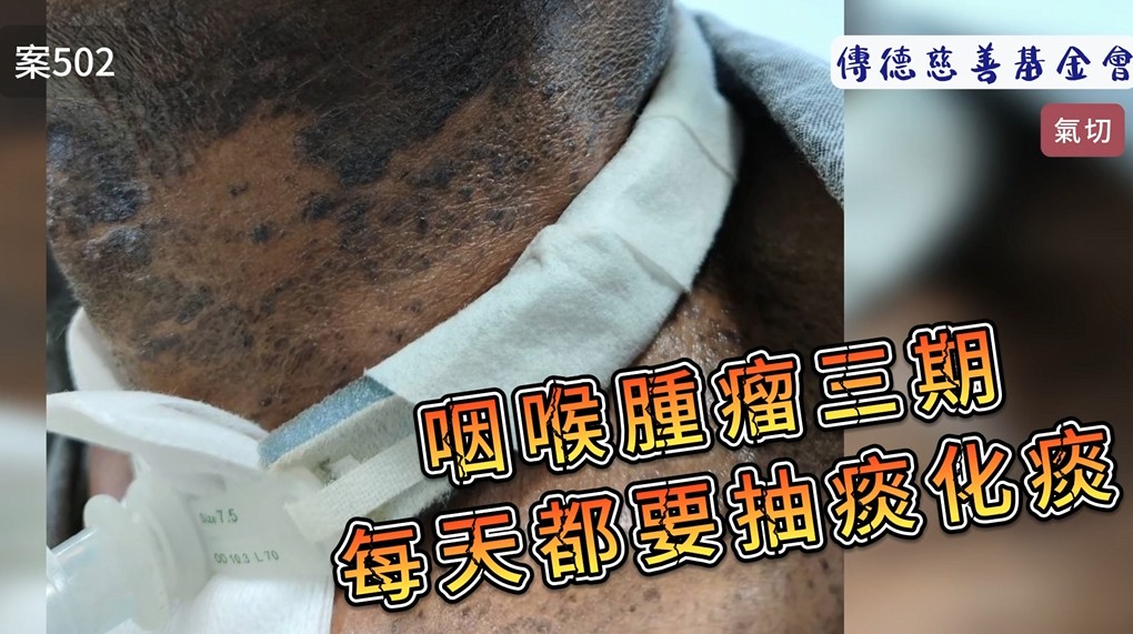 咽喉腫瘤三期，每天都要抽痰化痰...(標題圖檔)