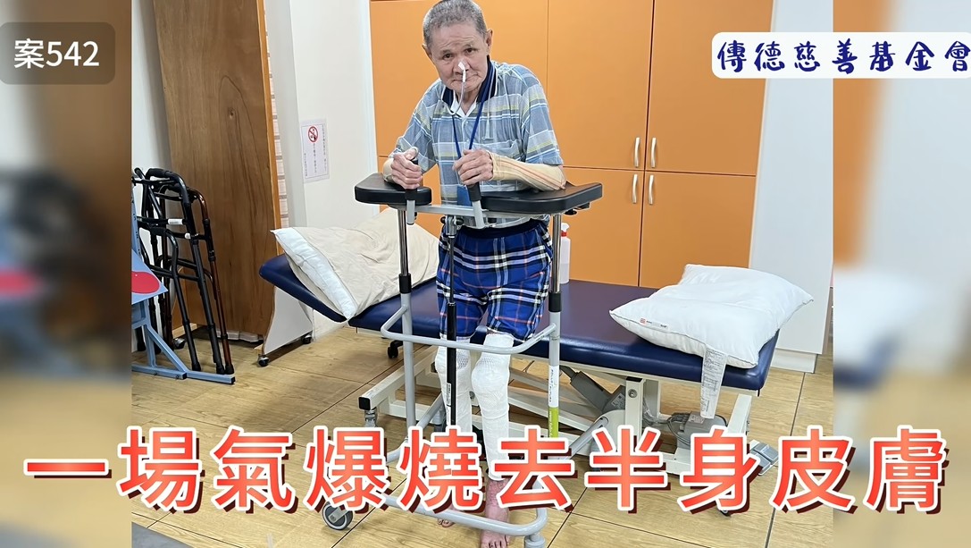 一場氣爆燒去半身皮膚(標題圖檔)