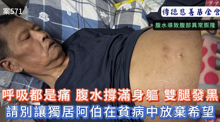 呼吸都是痛！腹水撐滿身軀、雙腿發黑，請別讓獨居阿伯在貧病交加中放棄希望(標題圖檔)